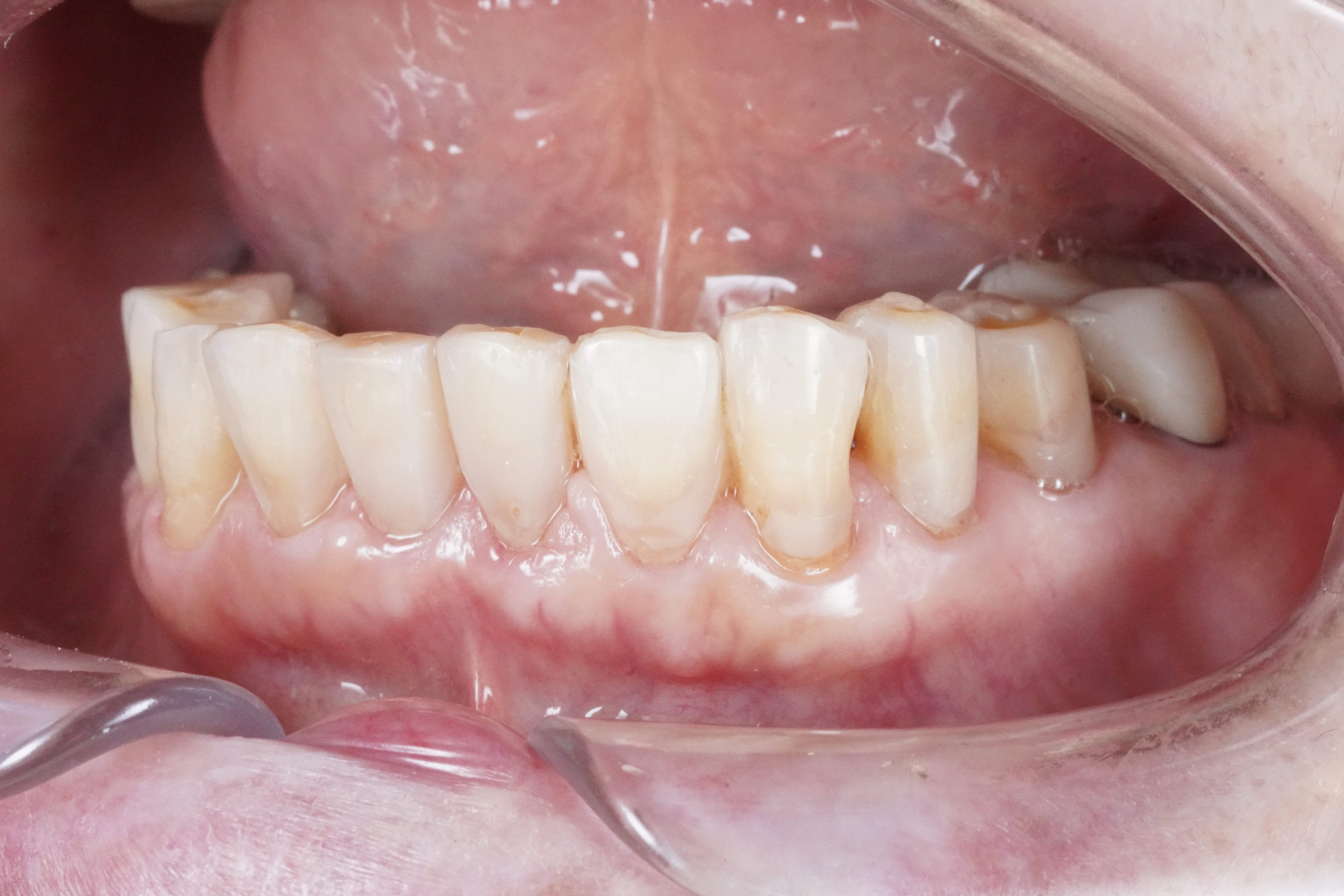 After treatment